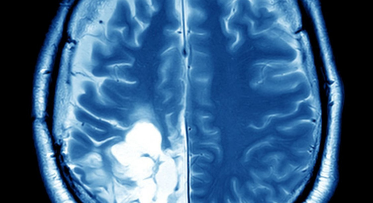 Brain Tumour Research - PhD Scholarship Opportunities