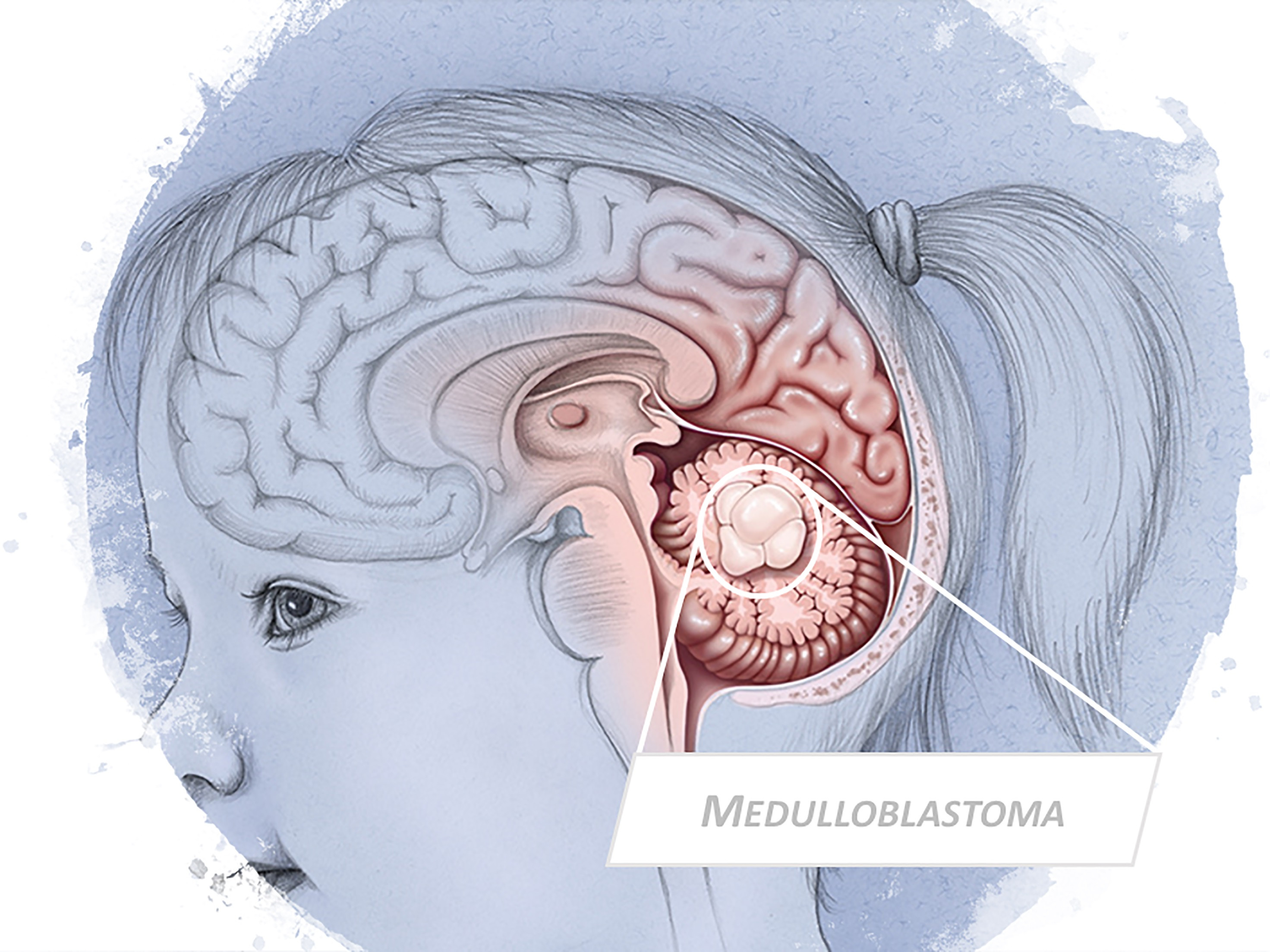 NRF Christmas Appeal: Paediatric Brain Tumours image