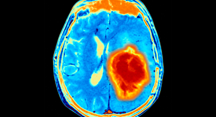 NRF achieves brain cancer fundraising goal ahead of schedule
