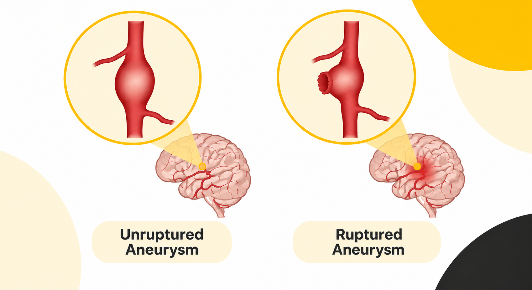 aneurysm graphic.png (1.06 MB)